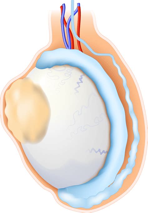 small soft lumo testes|soft lump on testicle cancer.